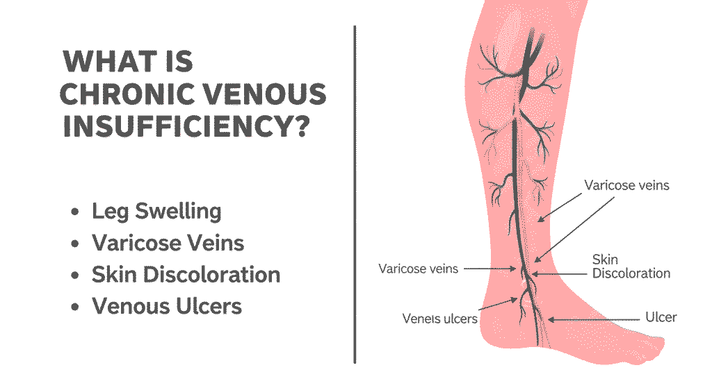Chronic Venous Insufficiency