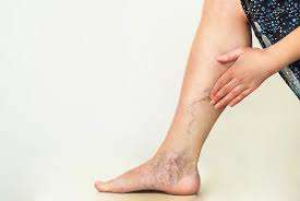 What is Chronic Venous Insufficiency